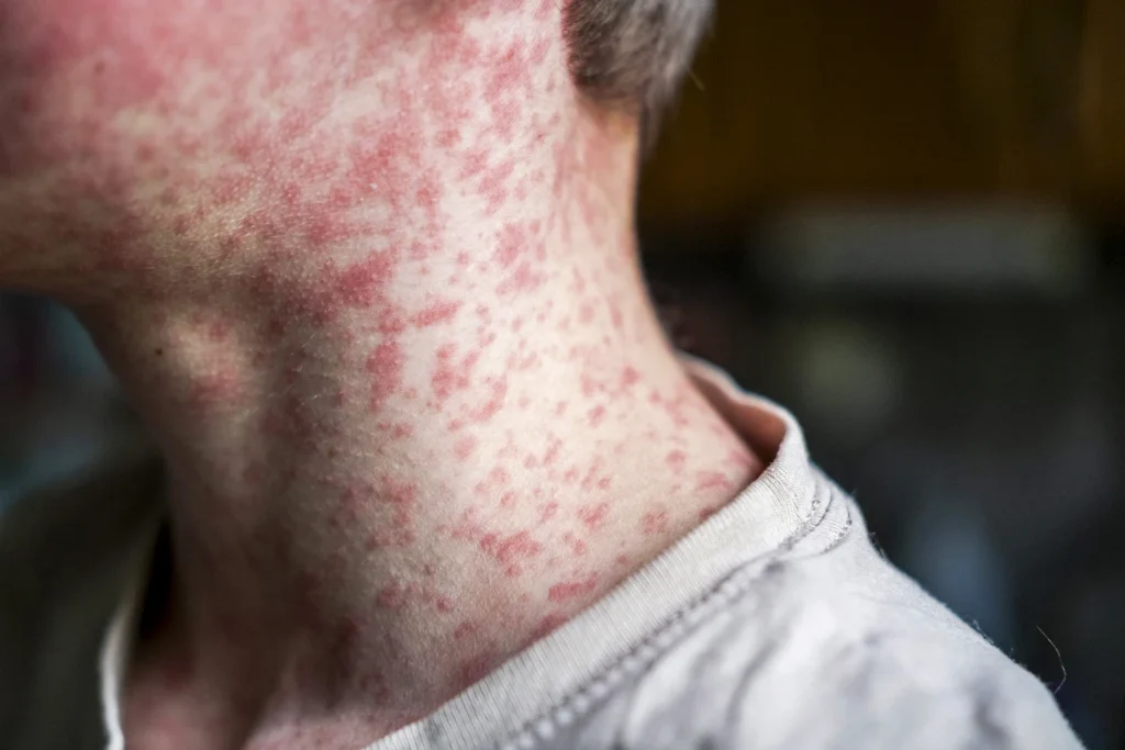 South Carolina Measles Outbreak, 111 Cases Force Legal Action as Hundreds Face Quarantine 1 South Carolina Measles Outbreak, 111 Cases Force Legal Action as Hundreds Face Quarantine