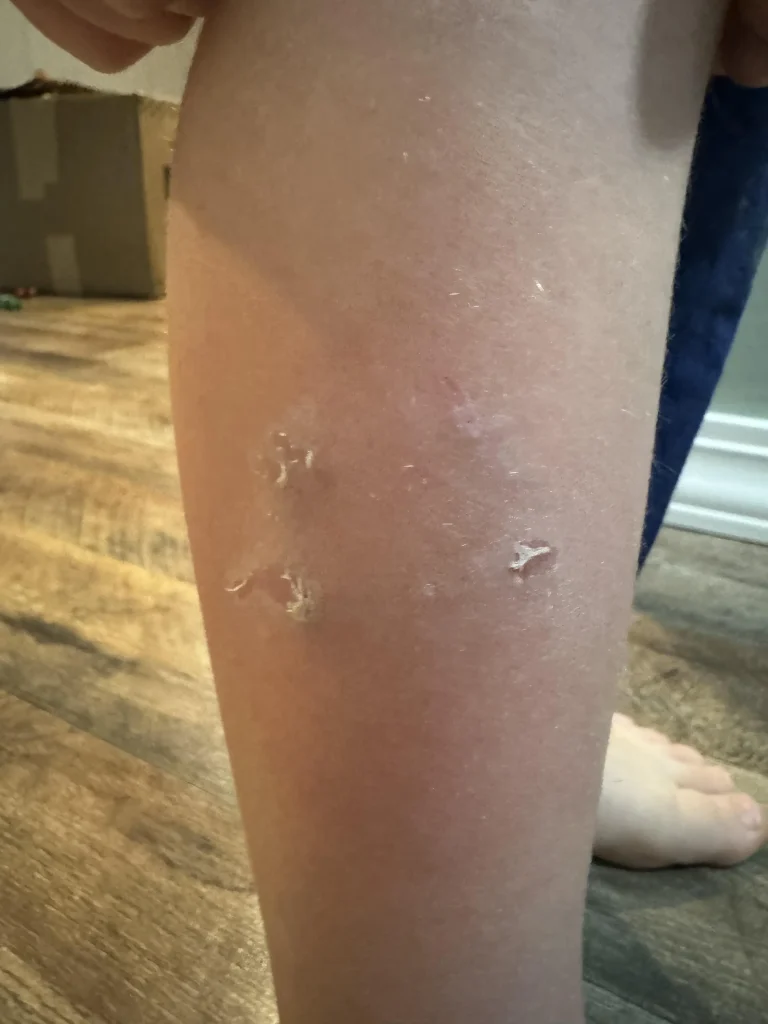 Neighbor Dog Lawsuits, Neighbor's Dog Mauled My Child, $400K Settlements and Jail Time for Owners