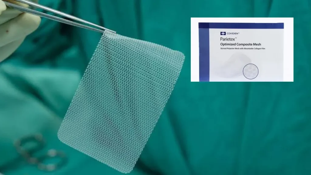 Covidien Hernia Mesh Lawsuit, Were You Affected