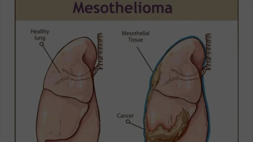 Mesothelioma Lawsuits in 2026, Verdicts, Settlements, and the J&J Talc Fight, What's Changed