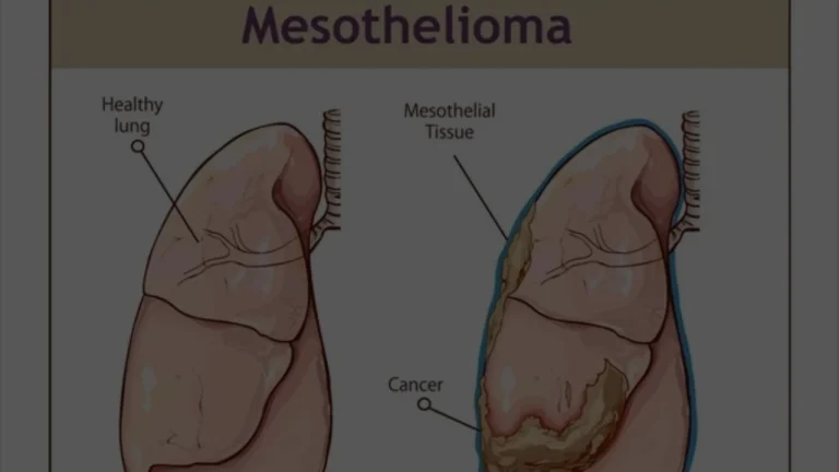 Mesothelioma Lawsuits in 2026, Verdicts, Settlements, and the J&J Talc Fight, What's Changed