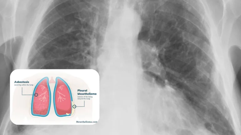 Queensland Plumber Robin Smith's A$1.897 Million Asbestosis Judgment, What the October 2026 Supreme Court of Queensland Decision Means for Asbestos Victims
